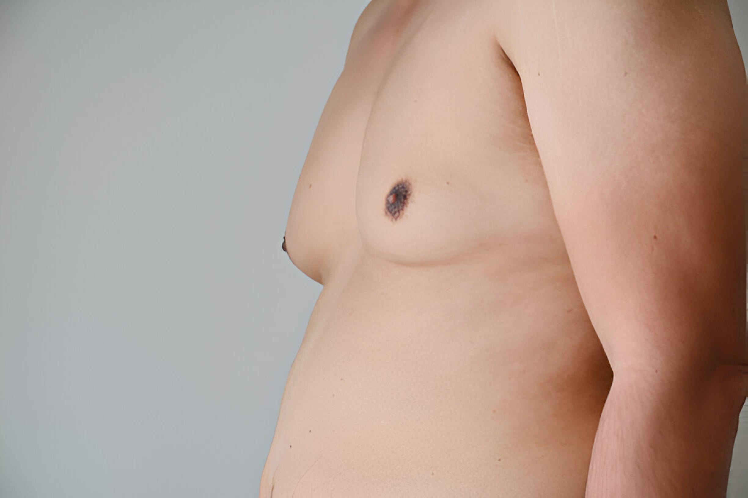  Gynecomastia in Chennai