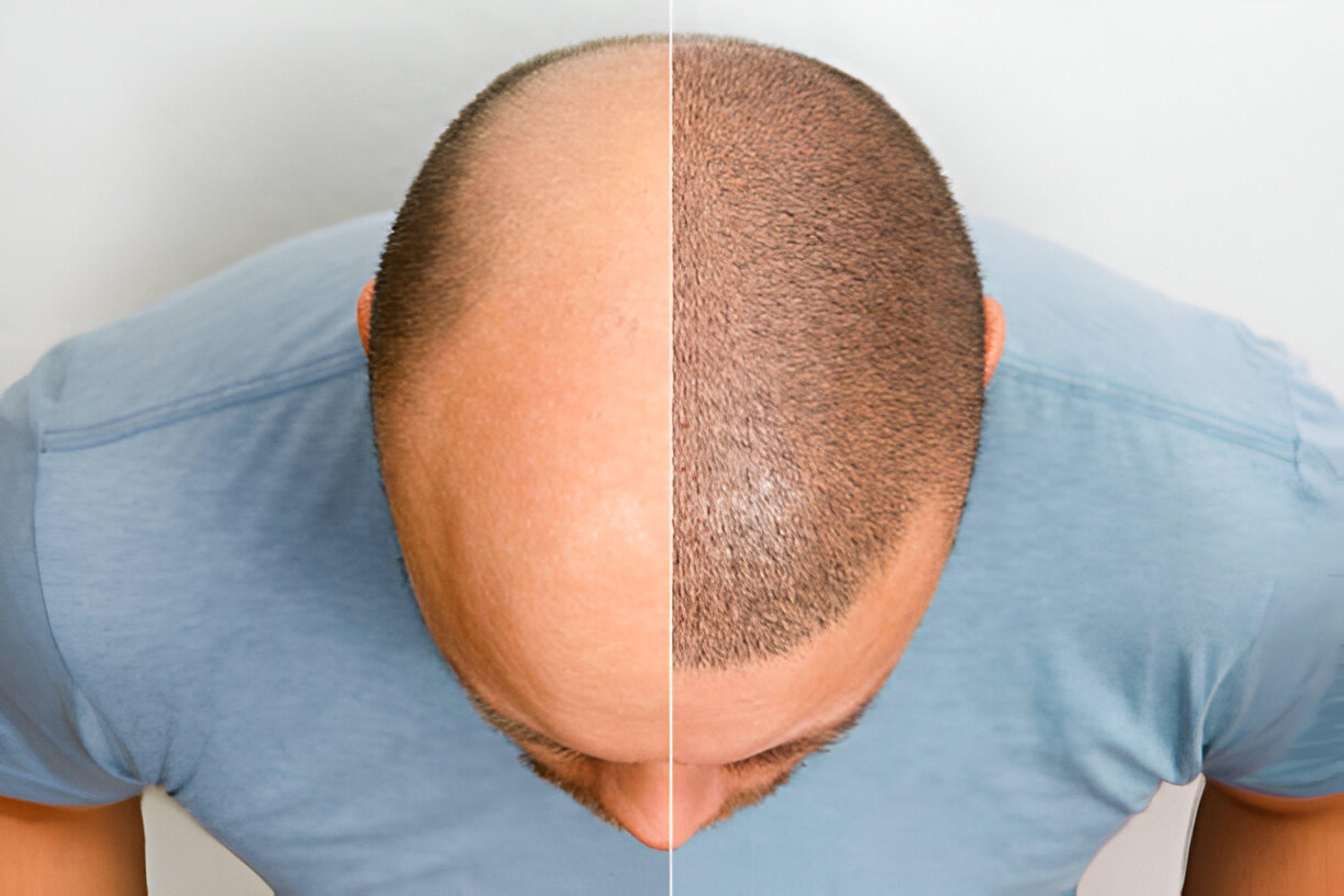 Hair transplant in Chennai