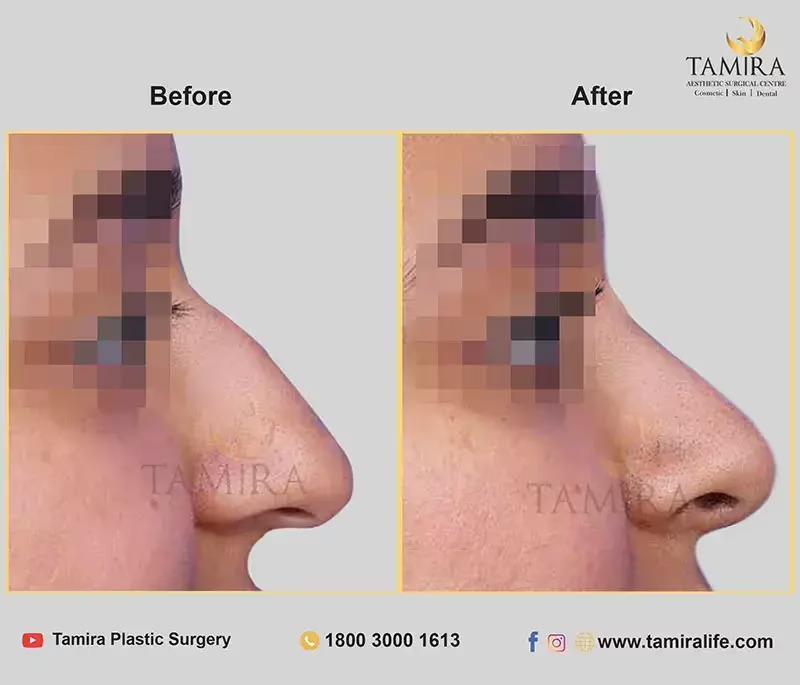 rhinoplasty before and after