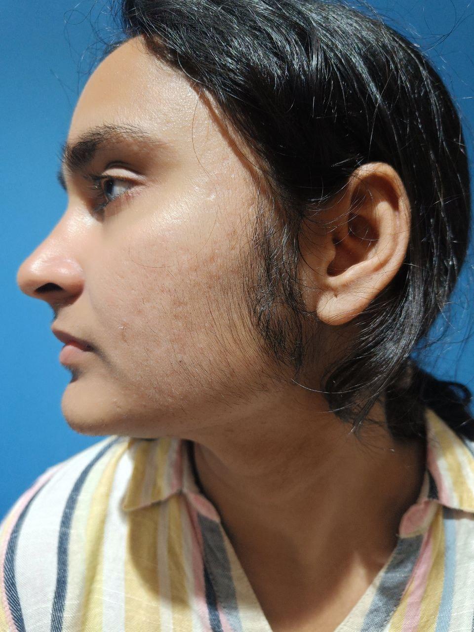 laser treatment for facial hair removal cost