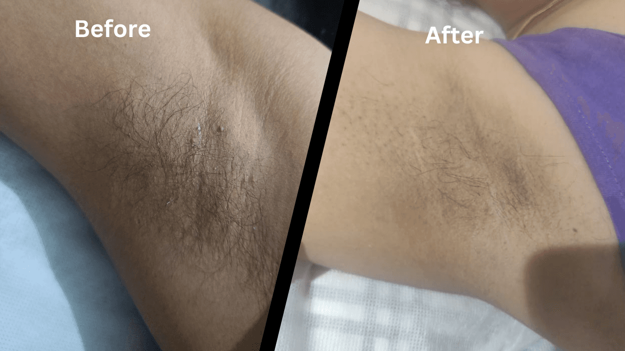 underarm laser hair removal cost