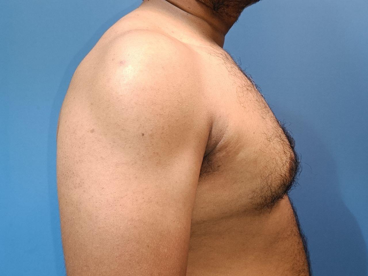 can gynecomastia go away naturally