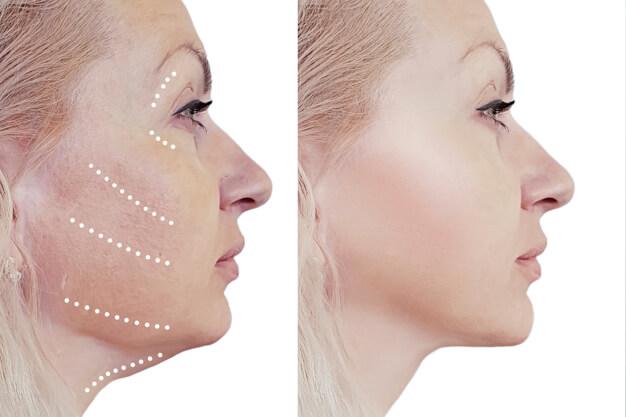 Image showing a woman before and after her thread lift treatment 